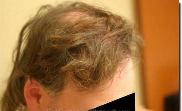 Hair restoration procedure results