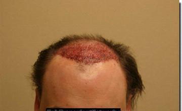 Hair restoration procedure results