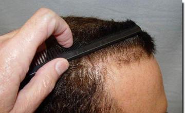 Hair restoration procedure results