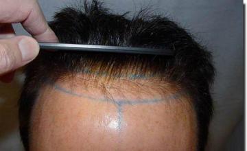 Hair restoration procedure results