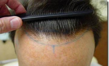 Hair restoration procedure results