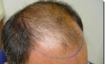 Hair restoration procedure results