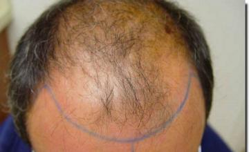 Hair restoration procedure results