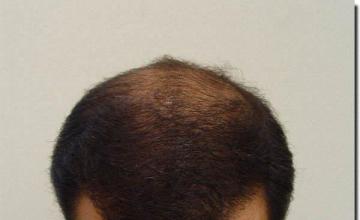 Hair restoration procedure results