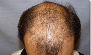 Hair restoration procedure results