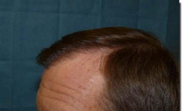 Hair restoration procedure results