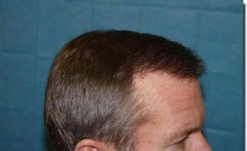 Hair restoration procedure results