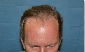 Hair restoration procedure results