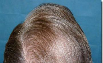 Hair restoration procedure results