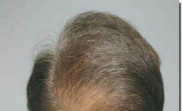 Hair restoration procedure results