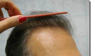 Hair restoration procedure results