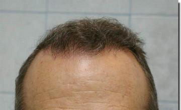 Hair restoration procedure results