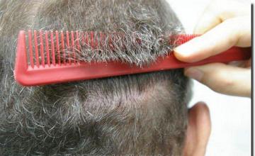 Hair restoration procedure results