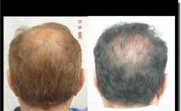 Hair restoration procedure results