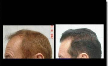 Hair restoration procedure results