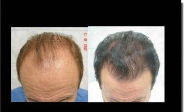 Hair restoration procedure results