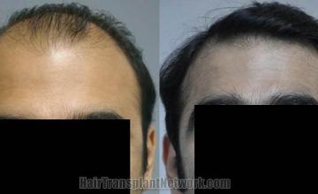 Hair restoration procedure results