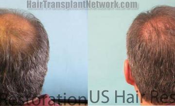 Back view before and after hair transplantation photos