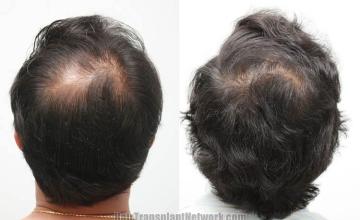 Hair restoration procedure before and after pictures