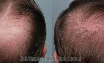 Hair transplantation surgery before and after photos