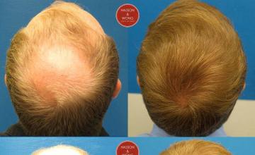 Hair transplantation surgery before and after photos