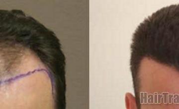 Hair transplant results front view