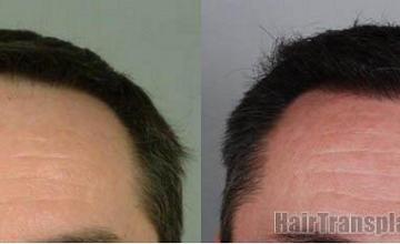 Hair restoration patient photos showing front view