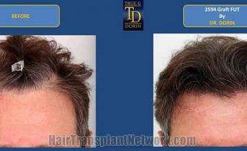 Hair restoration procedure before and after results