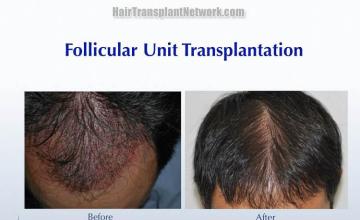 Hair restoration procedure before and after pictures