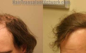 Left  view before and after hair transplantation pictures