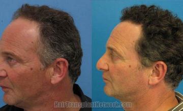 Hair restoration procedure results