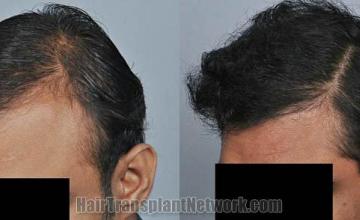 Hair transplantation surgery before and after photos