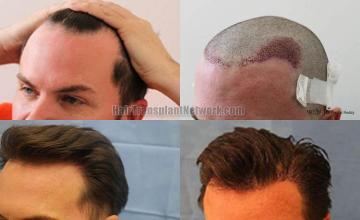 Hair transplantation surgery before and after pictures