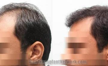 Hair transplantation surgery before and after images