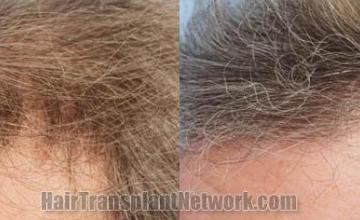 Hair transplantation surgery before and after images