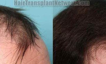 Hair transplantation surgery before and after images