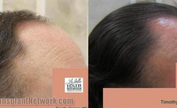 Hair transplantation surgery before and after photos