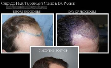 Hair transplantation surgery before and after photos