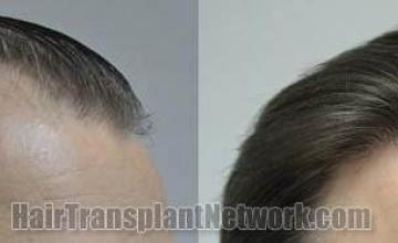 Hair transplantation surgery before and after images