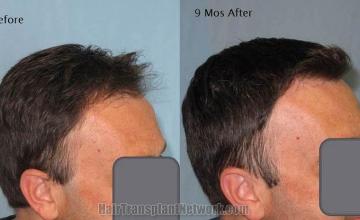 Hair transplantation surgery before and after pictures