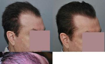 Hair transplantation surgery before and after images