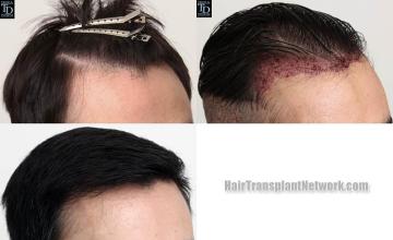 Hair transplantation surgery before and after images