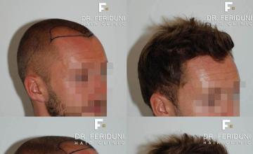 Hair restoration procedure before and after pictures