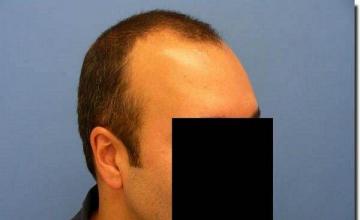 Hair restoration procedure results