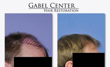 Hair restoration procedure before and after pictures