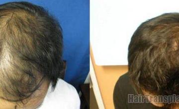 1742 grafts hair restoration results