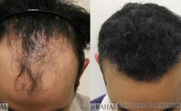 Top view - Before and after surgical hair replacement