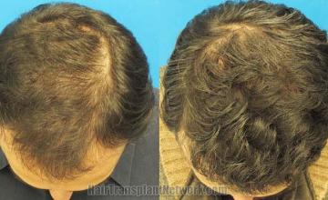 Hair transplantation surgery before and after photos