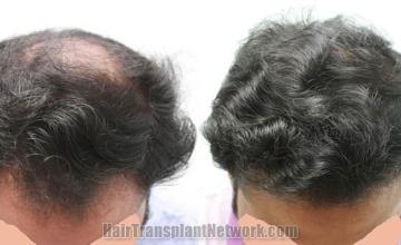 Top view before and after hair restoration results