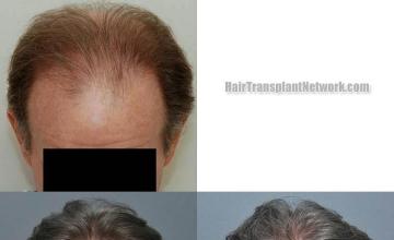 Hair transplantation surgery before and after photos